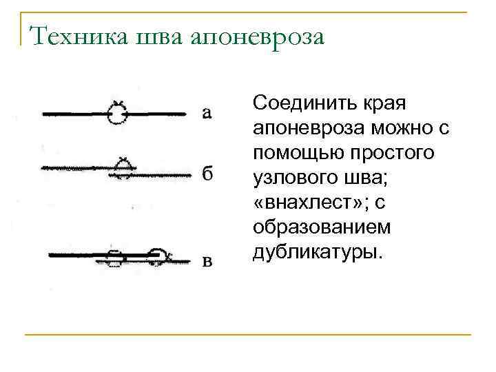 Техника шва апоневроза Соединить края апоневроза можно с помощью простого узлового шва; «внахлест» ;