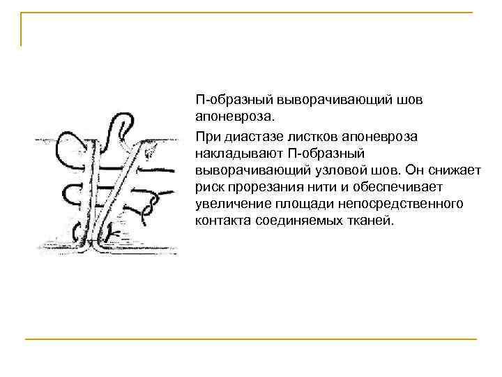 П-образный выворачивающий шов апоневроза. При диастазе листков апоневроза накладывают П-образный выворачивающий узловой шов. Он