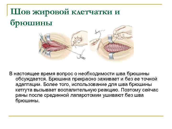Шов жировой клетчатки и брюшины В настоящее время вопрос о необходимости шва брюшины обсуждается.