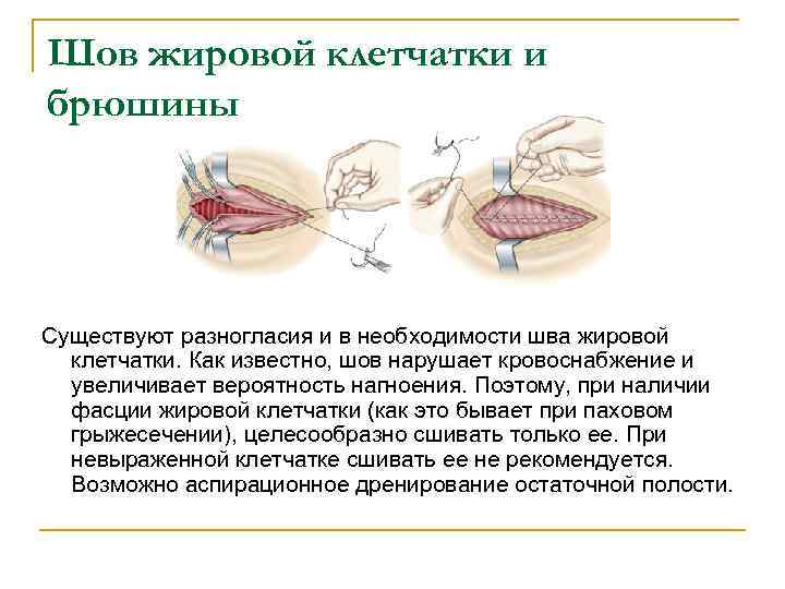 Шов жировой клетчатки и брюшины Существуют разногласия и в необходимости шва жировой клетчатки. Как