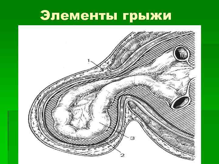 Паховая грыжа у мужчин где находится картинка