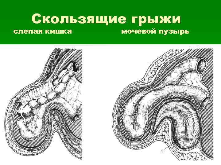 Паховая грыжа у мужчин где находится картинка