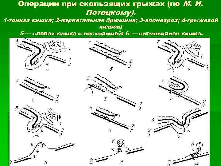 Скользящая грыжа. Схема скользящей грыжи. Скользящая грыжа операция. Операции при скользящих грыжах. Особенности операции при скользящей грыже.