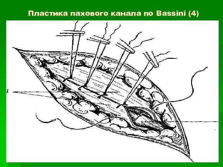 Пластика пахового канала по бассини