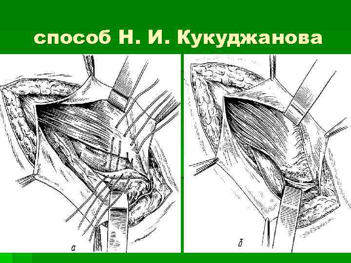 Способ н. Метод Бассини и Кукуджанова. Пластика пахового канала Кукуджанова. Кукуджанов паховые грыжи. Грыжесечение по Кукуджанову схема.