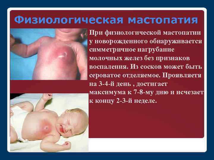 Физиологическая мастопатия При физиологической мастопатии у новорожденного обнаруживается симметричное нагрубание молочных желез без признаков