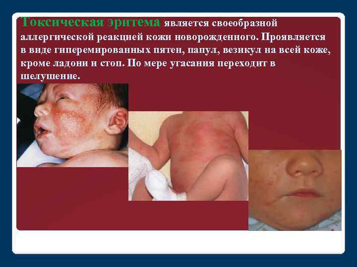 Токсическая эритема является своеобразной аллергической реакцией кожи новорожденного. Проявляется в виде гиперемированных пятен, папул,