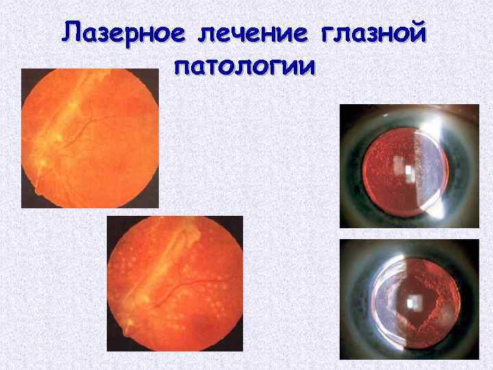 Лазерное лечение глазной патологии 