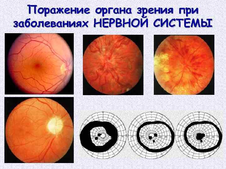 Поражение органа зрения при заболеваниях НЕРВНОЙ СИСТЕМЫ 