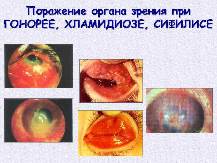 Поражение органа зрения при ГОНОРЕЕ, ХЛАМИДИОЗЕ, СИФИЛИСЕ 