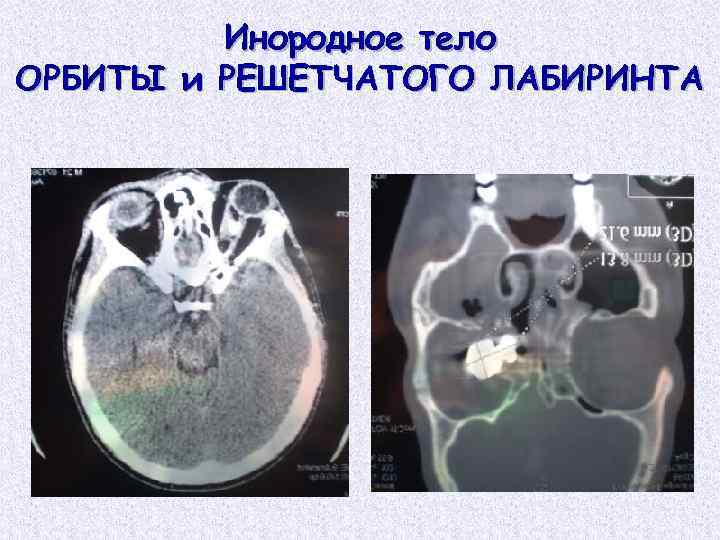 Инородное тело ОРБИТЫ и РЕШЕТЧАТОГО ЛАБИРИНТА 