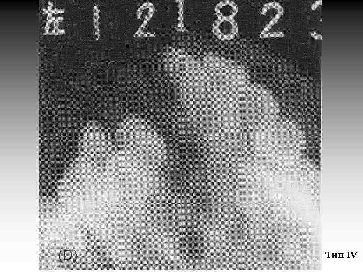 Тип IV 