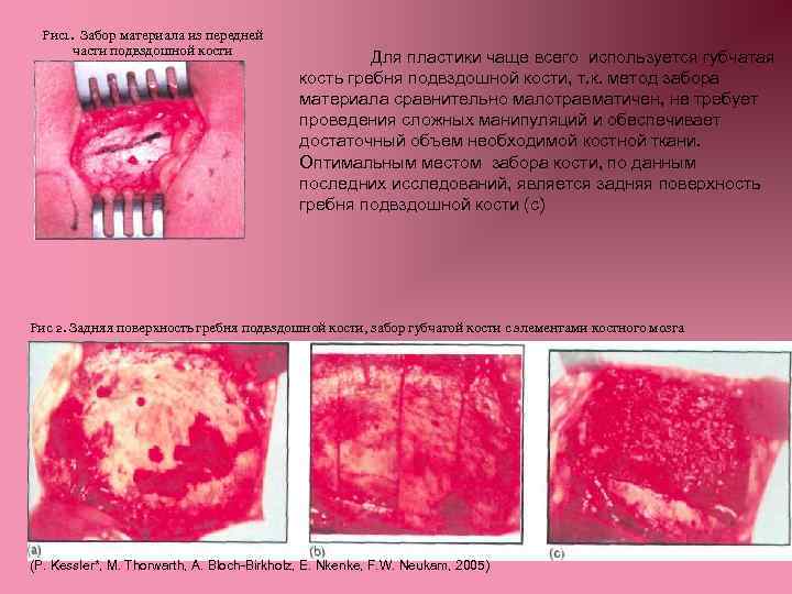Рис1. Забор материала из передней части подвздошной кости Для пластики чаще всего используется губчатая