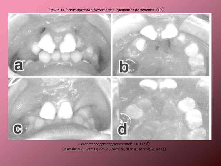 Рис. 11 -14. Внутриротовая фотография, сделанная до лечения (a, b) После проведения двухэтапной ВКП