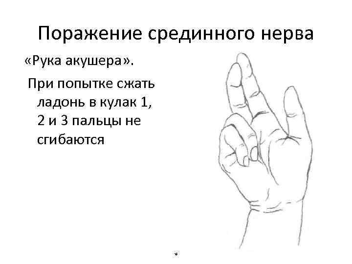 Поражение срединного нерва «Рука акушера» . При попытке сжать ладонь в кулак 1, 2