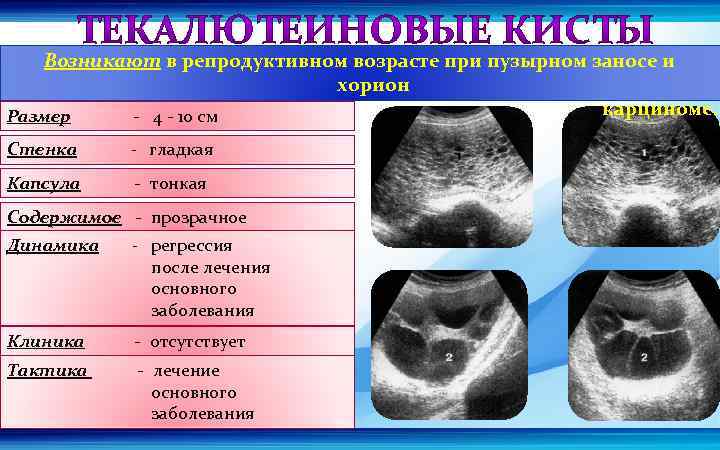 Возникают в репродуктивном возрасте при пузырном заносе и хорион карциноме. Размер - 4 -