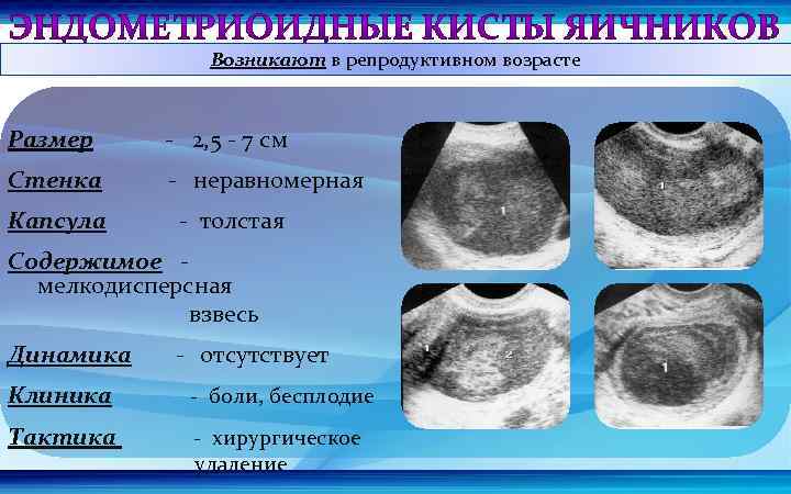 Возникают в репродуктивном возрасте Размер - 2, 5 - 7 см Стенка - неравномерная