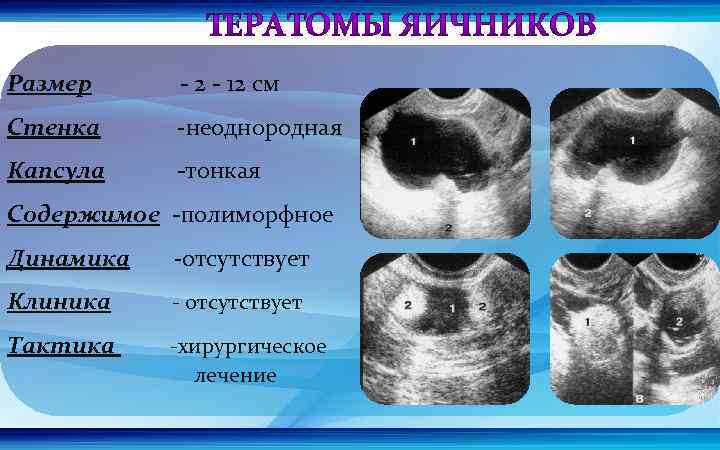 Размер - 2 - 12 см Стенка -неоднородная Капсула -тонкая Содержимое -полиморфное Динамика -отсутствует