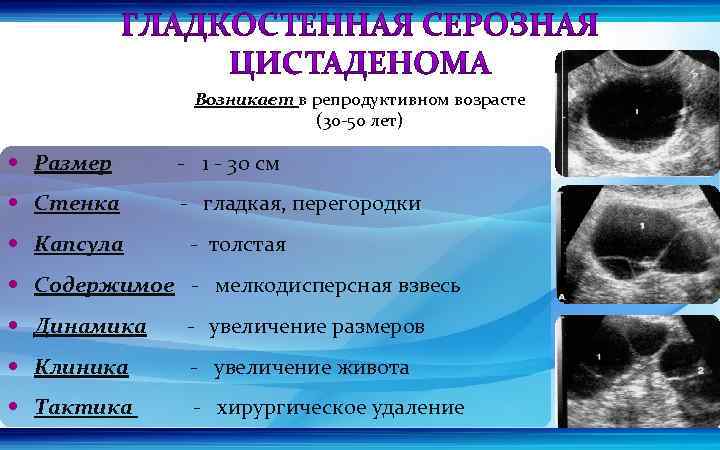 Возникает в репродуктивном возрасте (30 -50 лет) Размер - 1 - 30 см Стенка