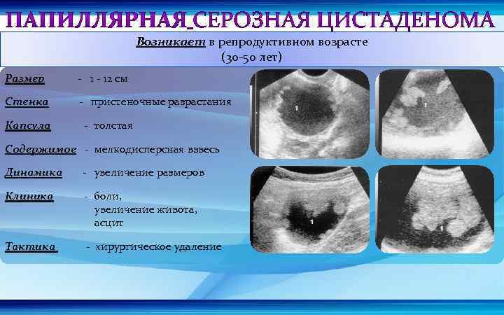 Возникает в репродуктивном возрасте (30 -50 лет) Размер - 12 см Стенка - пристеночные