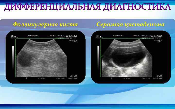 Фолликулярная киста Серозная цистаденома 