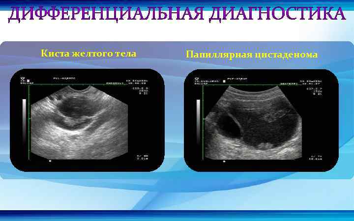 Киста желтого тела Папиллярная цистаденома 