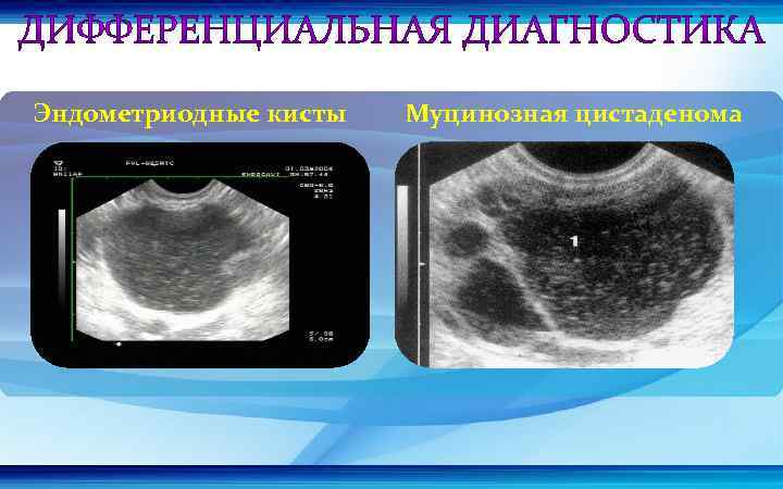 Эндометриодные кисты Муцинозная цистаденома 