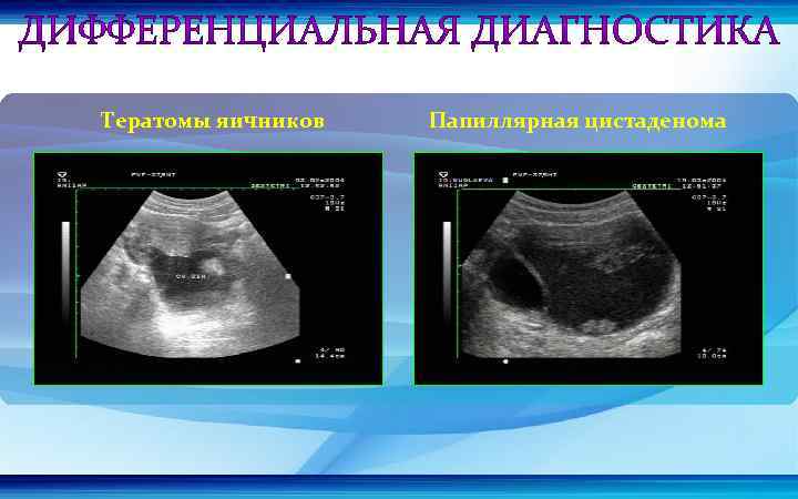 Тератомы яичников Папиллярная цистаденома 