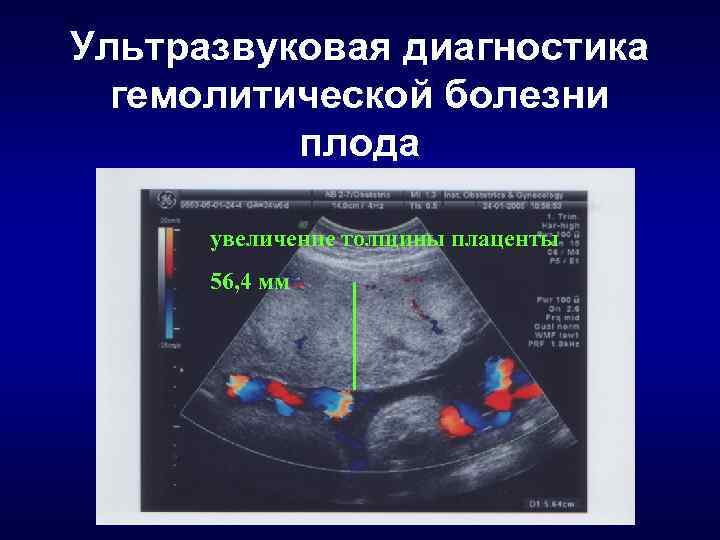 Ультразвуковая диагностика гемолитической болезни плода увеличение толщины плаценты 56, 4 мм 