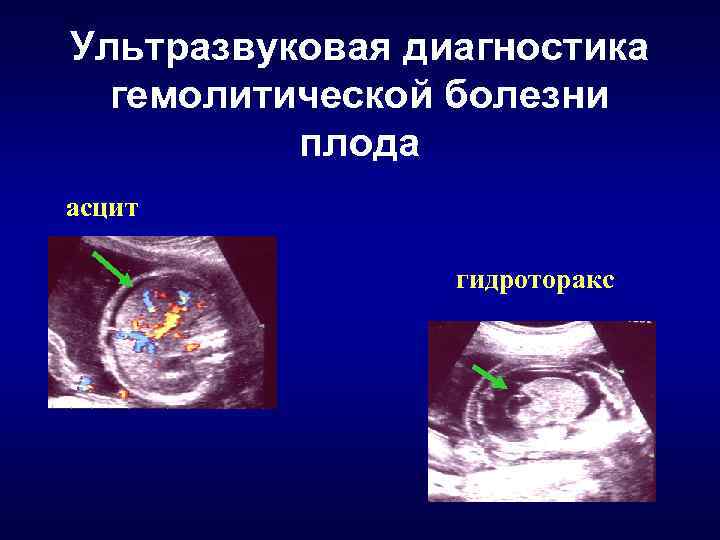 Ультразвуковая диагностика гемолитической болезни плода асцит гидроторакс 