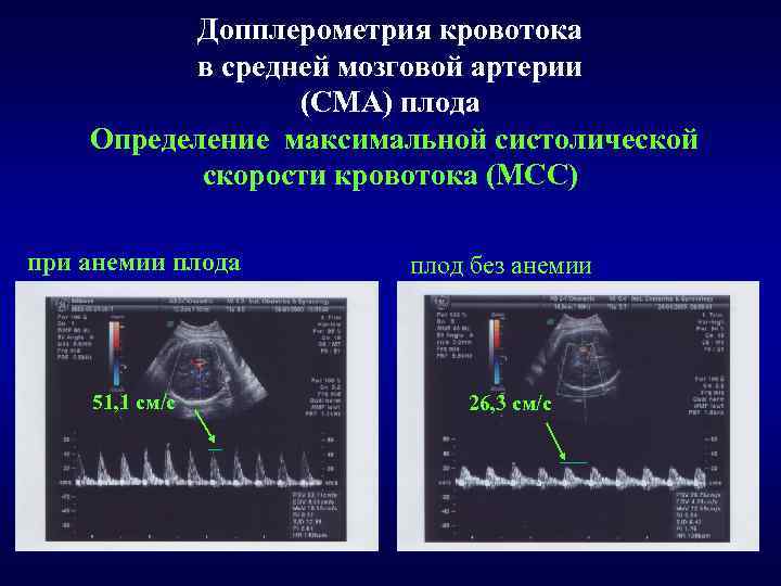 Допплерометрия кровотока в средней мозговой артерии (СМА) плода Определение максимальной систолической скорости кровотока (МСС)