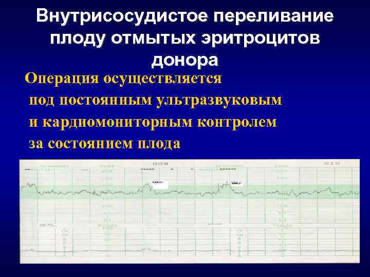 Внутрисосудистое переливание плоду отмытых эритроцитов донора Операция осуществляется под постоянным ультразвуковым и кардиомониторным контролем