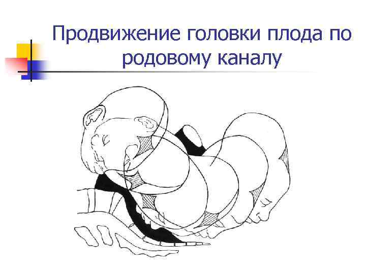 Продвижение головки плода по родовому каналу 