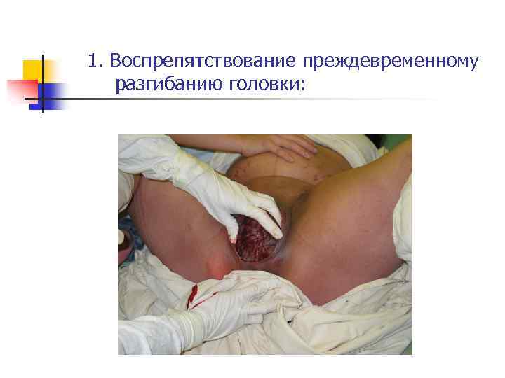 1. Воспрепятствование преждевременному разгибанию головки: 