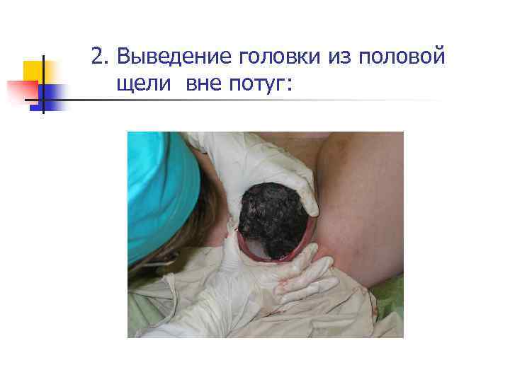 2. Выведение головки из половой щели вне потуг: 