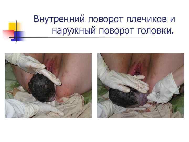 Внутренний поворот плечиков и наружный поворот головки. 