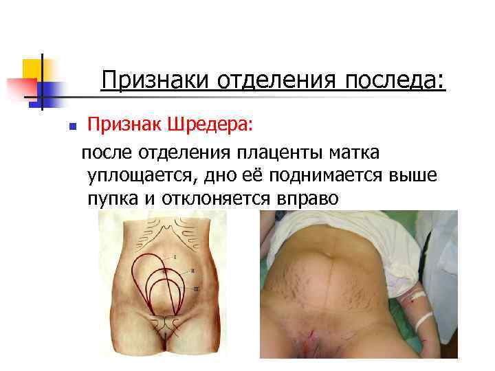 Признаки отделения последа: n Признак Шредера: после отделения плаценты матка уплощается, дно её поднимается
