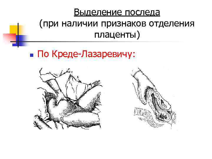 Выделение последа (при наличии признаков отделения плаценты) n По Креде-Лазаревичу: 