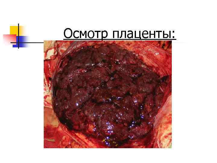Осмотр плаценты: 