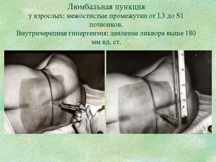 Люмбальная пункция у взрослых: межостистые промежутки от L 3 до S 1 позвонков. Внутричерепная