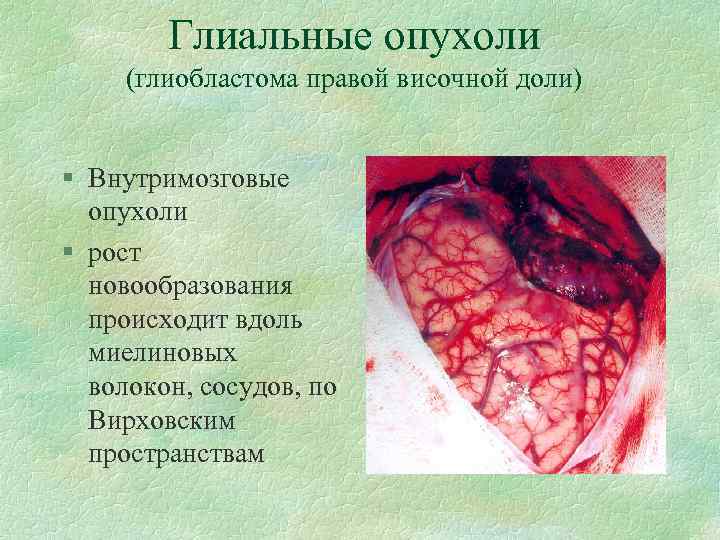 Глиальные опухоли (глиобластома правой височной доли) § Внутримозговые опухоли § рост новообразования происходит вдоль