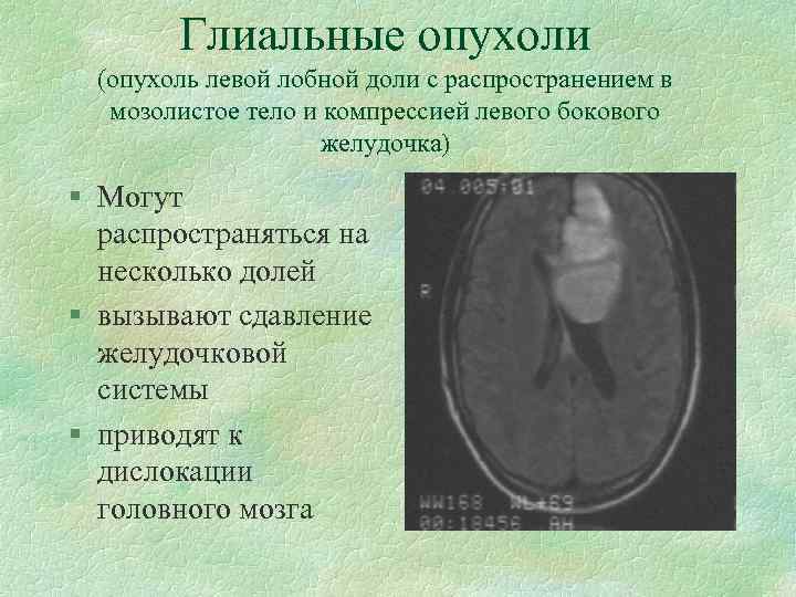 Глиальные опухоли (опухоль левой лобной доли с распространением в мозолистое тело и компрессией левого