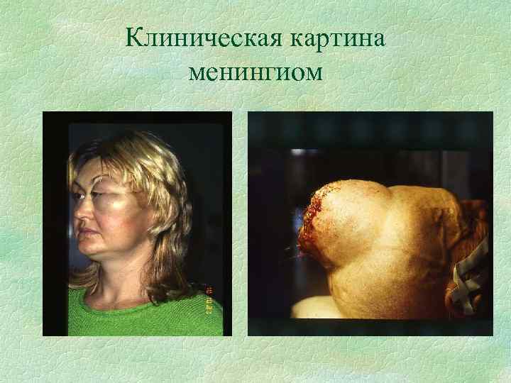 Клиническая картина менингиом 