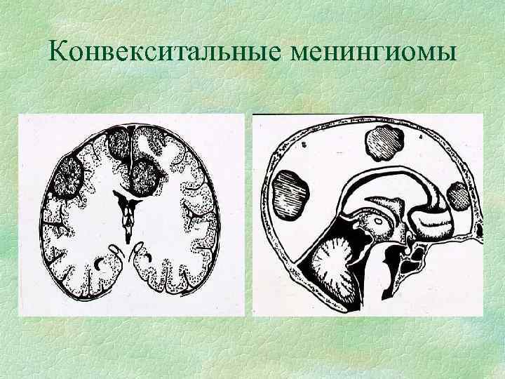 Конвекситальные менингиомы 