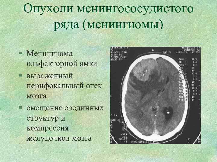 Опухоли менингососудистого ряда (менингиомы) § Менингиома ольфакторной ямки § выраженный перифокальный отек мозга §