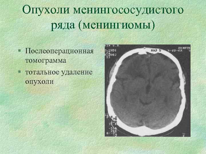 Опухоли менингососудистого ряда (менингиомы) § Послеоперационная томограмма § тотальное удаление опухоли 