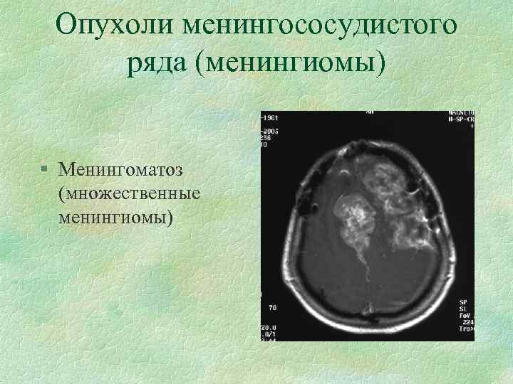 Опухоли менингососудистого ряда (менингиомы) § Менингоматоз (множественные менингиомы) 