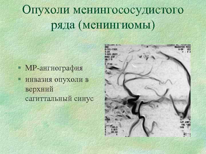 Опухоли менингососудистого ряда (менингиомы) § МР-ангиография § инвазия опухоли в верхний сагиттальный синус 