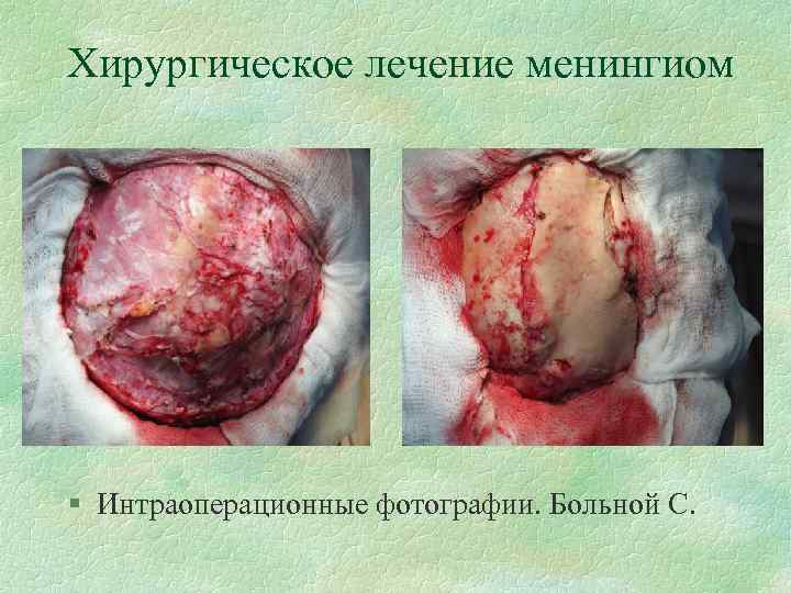 Хирургическое лечение менингиом § Интраоперационные фотографии. Больной С. 