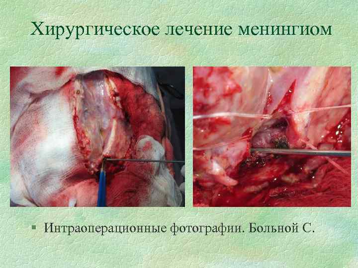 Хирургическое лечение менингиом § Интраоперационные фотографии. Больной С. 